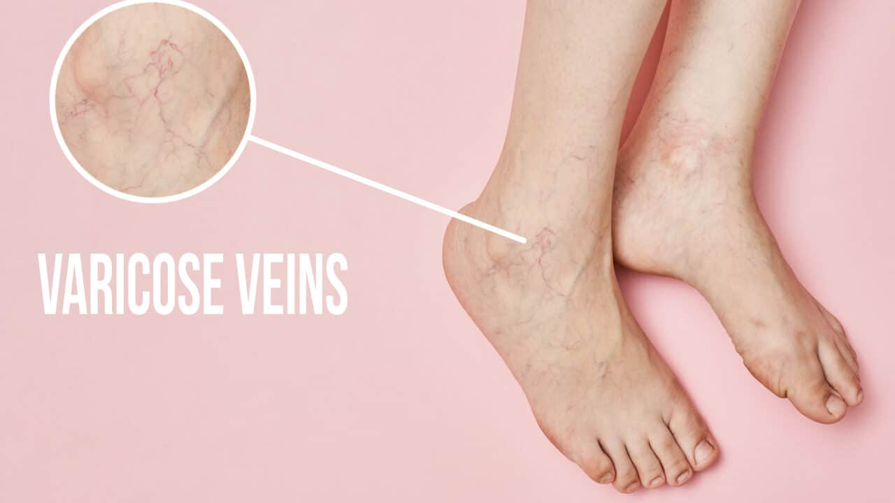 Varicose veins on women feet